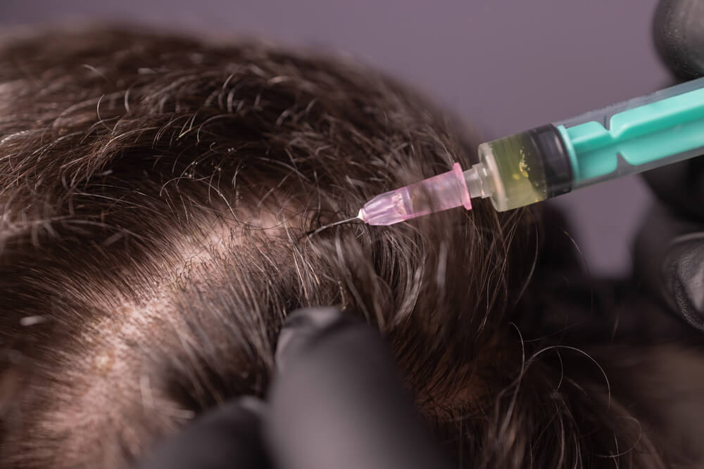 PRP scalp injection for hair loss treatment in male patient