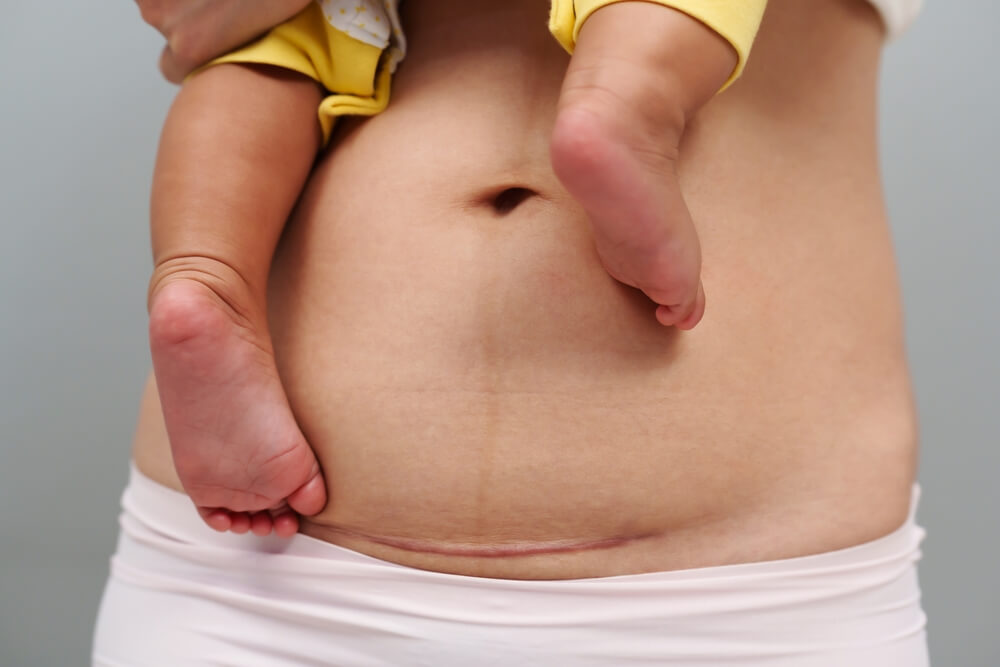 Postpartum woman with C-section scar symbolising recovery and vaginal tightening after VOTIVA RF therapy